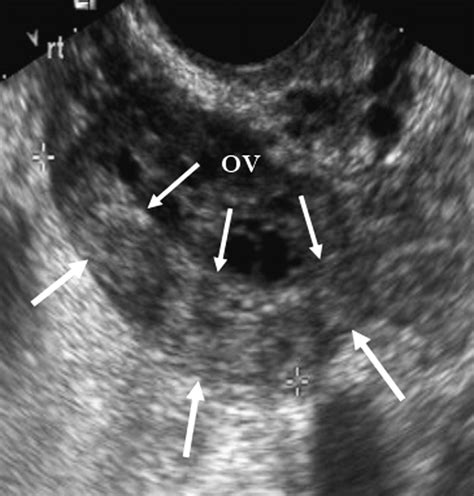 Normal Ovary Transvaginal Ultrasound