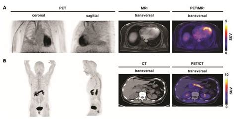 Imaging Inflammation with Positron Emission Tomography