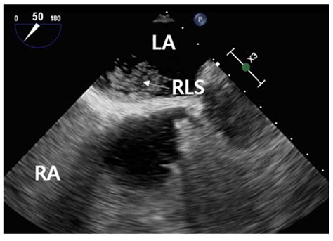 Right-to-Left Shunt Evaluation in Cardiac Patent Foramen Ovale Using Bubble Contrast ...