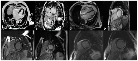 Targeting Ventricular Arrhythmias in Non-Ischemic Patients: Advances in ...