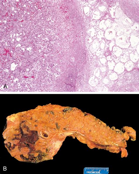 Pancreas - Clinical Tree