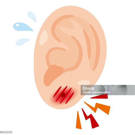 Illustration Of An Inflamed Ear Caused By A Piercing Stock Illustration ...