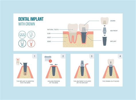Dental Extraction Implant Process at Sherri Branch blog