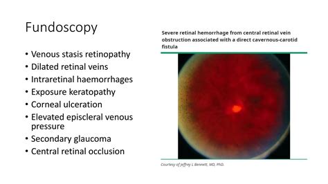 Carotid Cavernous Fistulas | PPTX