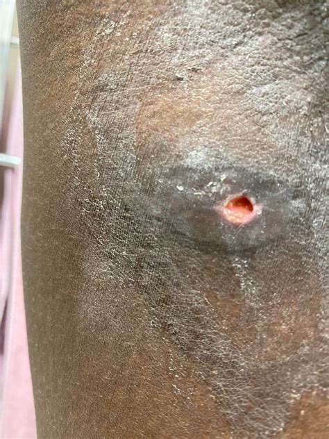 Hole underneath armpit : r/DermatologyQuestions