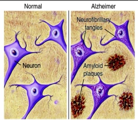 Fig. 5: A representation of the basic histology of Alzheimer’s Disease ...