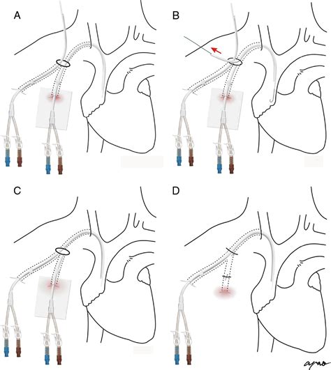 Modified Exchange Technique for Management of Dysfunctional Tunneled ...