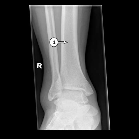 Normal Left Ankle Xray