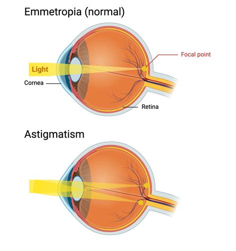 Astigmatism Creates Multiple Focal Points | BioRender Science Templates
