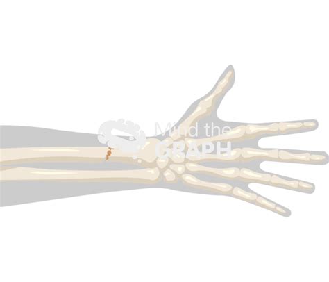 Radius Fracture 的图像结果