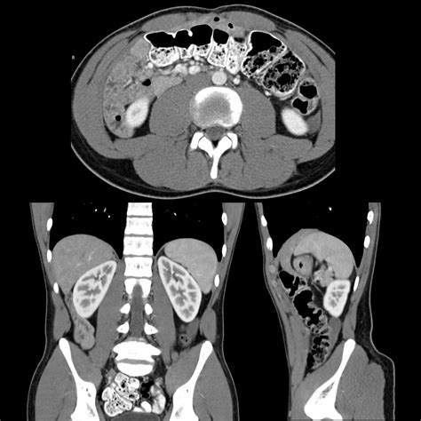 What Is Undescended Testicles at Kevin Marsh blog