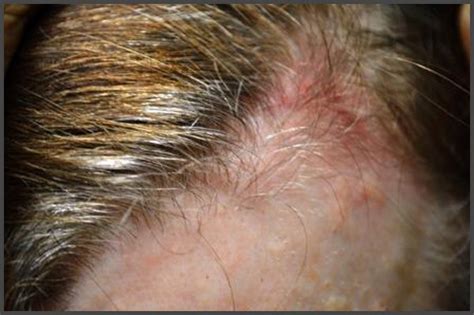 Pictures of shingles on the scalp | Shingles Expert