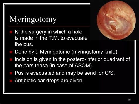 Acute otitis media (AOM) secretory otitis media (OME) | PPT