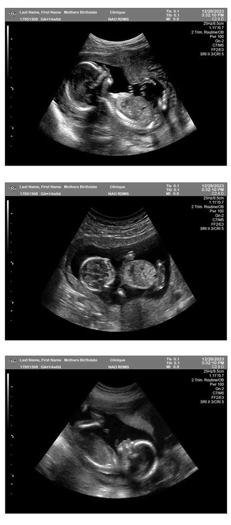 14 Weeks Pregnant Ultrasound - Ultrasounds