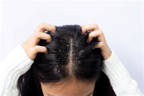 Reasons for dandruff in summer | Head and Shoulders IN