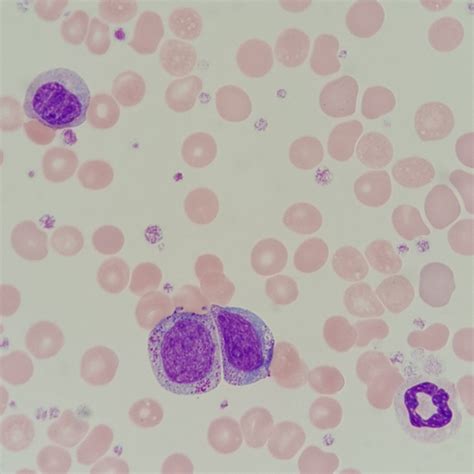Pelger-Huet / Pelgeroid: Appearance & Clinical Significance - MedLabBuddy