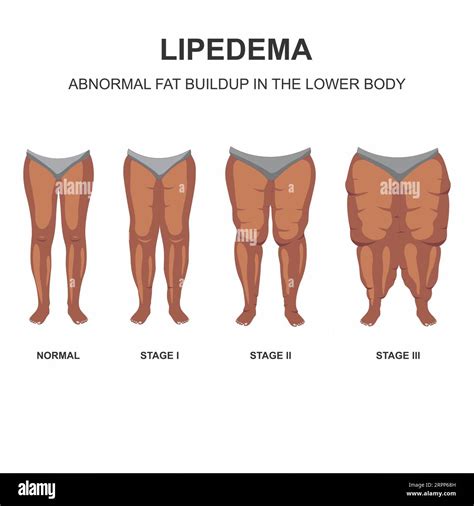 Lipedema stages illustration Stock Photo - Alamy
