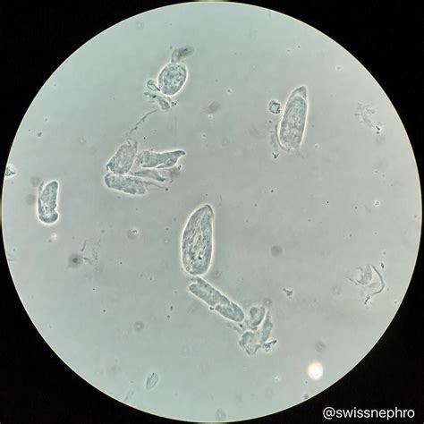 Understanding Urinary Sediment: Hyaline Casts in Diuretic Therapy