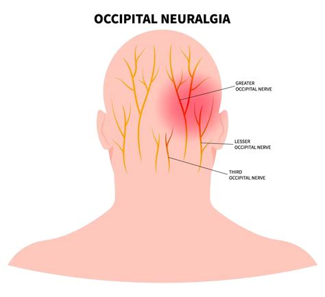 Occipital Nerve Greater Occipital Nerve Block PainScience