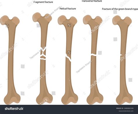 Types Bone Fractures How Bones Break Stock Vector (Royalty Free) 2480892209 | Shutterstock