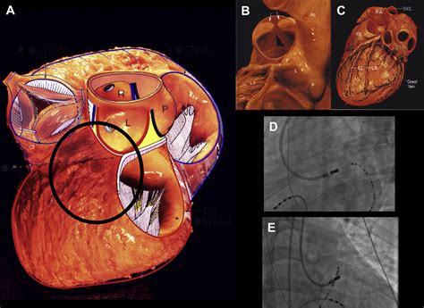 Heart Ablation For Svt at Kimberly Betts blog