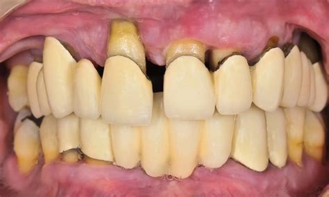 Systemic amoxicillin and metronidazole effective in patients with ...