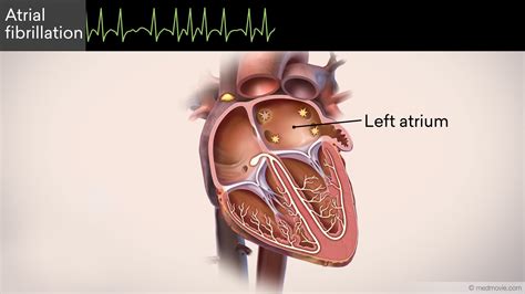 Atrial Flutter
