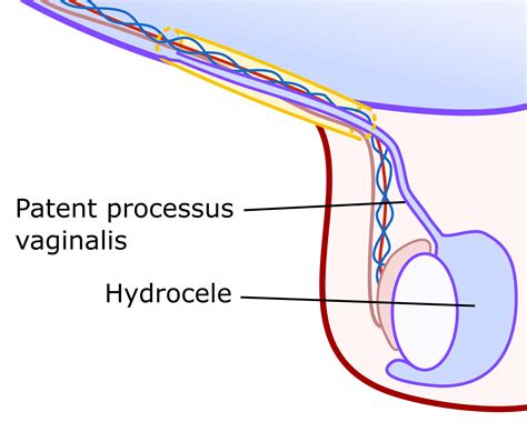 Hydrocele | Scrotal Lump | Geeky Medics