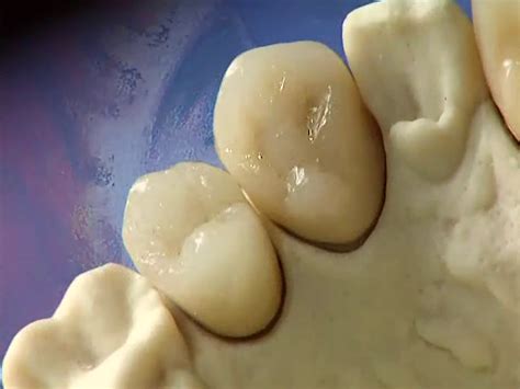 Passive-fit implant-supported maxillary anterior bridge | Quintessenz ...