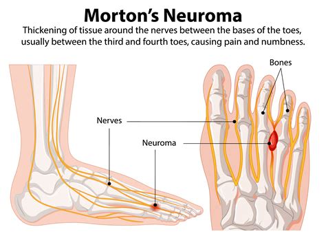 Morton's Neuroma Treatment London | Flawless Feet