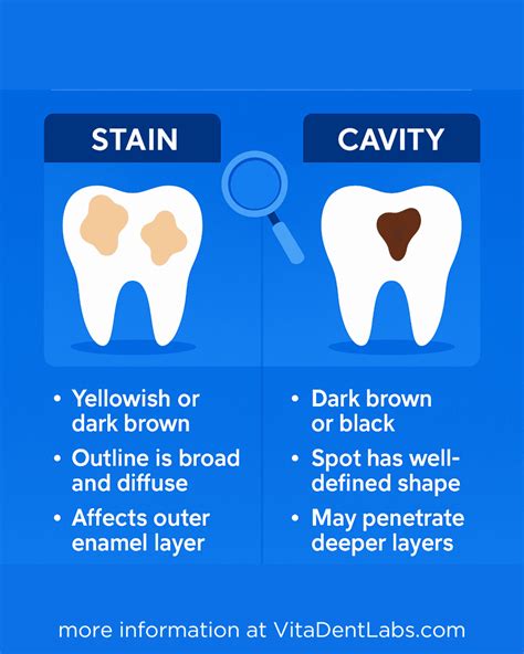 Brown Spots on Teeth: Cavity or Stain? (Complete Guide)