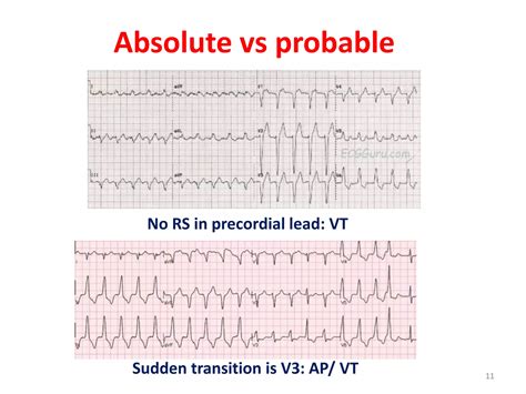 Supraventricular tachycardia: ECG recognition and diagnosis | PPTX