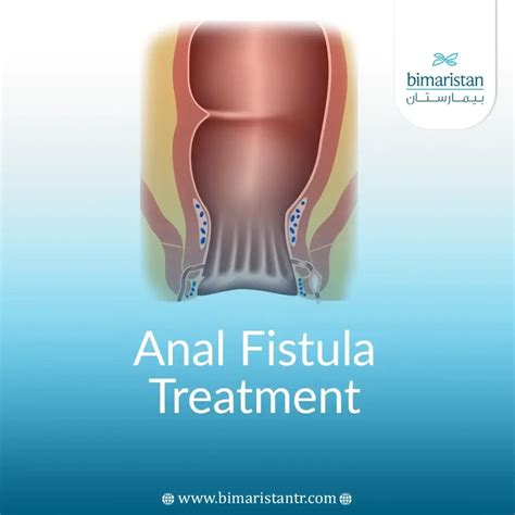 Anal Fistula Treatment: Best Options for Fast Recovery