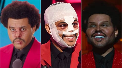 Is The Weeknd's Plastic Surgery Real? Photos, Details