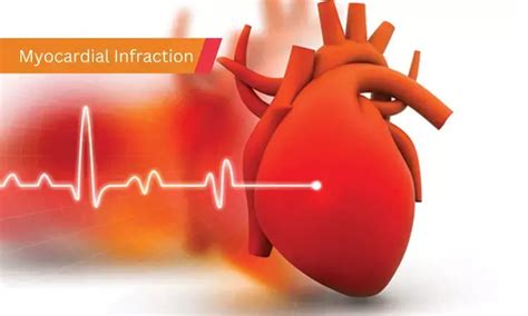 PCSK9 inhibitors act through plaque stabilisation not by improving ...