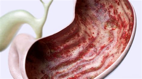 Los 7 tipos de gastritis - Muy Salud
