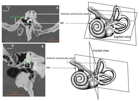 Anatomical Variations of Modiolus in Relation with Vestibular and ...