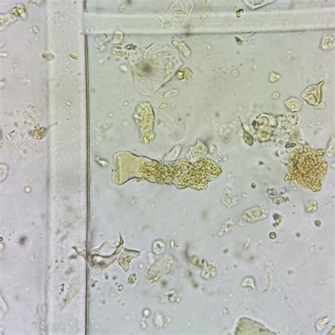 Waxy Casts: Identification & Significance - MedLabBuddy