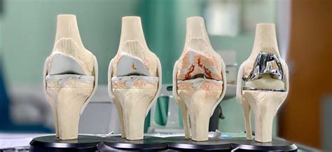 Treatment of Osteoarthritis of the Knee and Knee Replacement Surgery – Dr Willem Pretorius ...