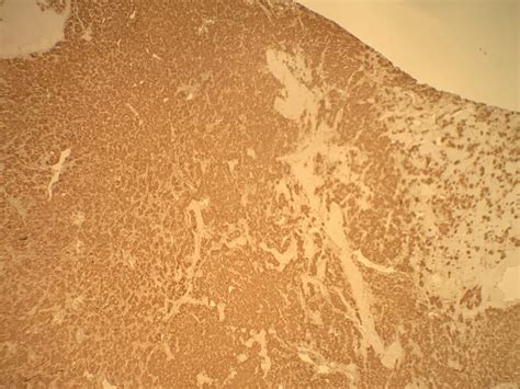 Case 1111 - Man in his 50s with Periodic Sweating and Diarrhea | Department of Pathology