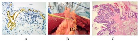 The Development of Peritoneal Metastasis from Gastric Cancer and ...