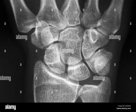 Carpal Tunnel View X Ray at Danica Jones blog
