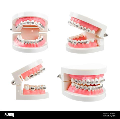 Set teeth model with metal wire dental braces or dental instruments isolated on white background ...