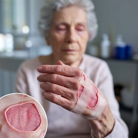 Effective Strategies on how to care for skin tears in older people: Prevention Tips