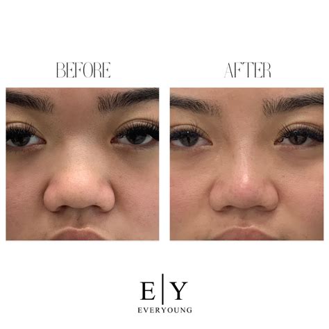 Surgical VS Non-Surgical Nose Jobs