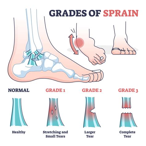 Types Of Sprains Ankle