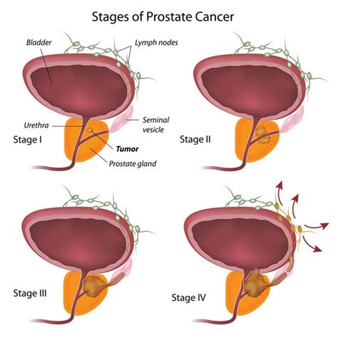 Prostate Cancer 的图像结果