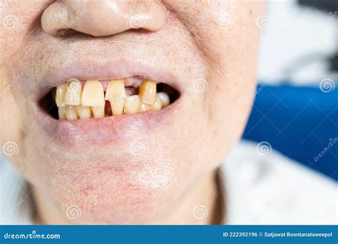 Close Up,Mouth of Old Elderly with Chipped a Tooth,show a Loose Broken Tooth,smile with Bad ...