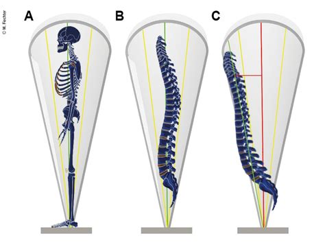 ALIF versus TLIF mit ALL-Release - Orthopädie & Traumatologie ...