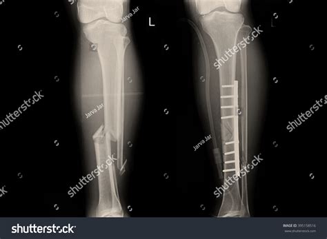 X-ray Show Fracture Leg Tibia Fibular Stock Photo 395158516 | Shutterstock